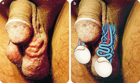 Nov 22, 2016 · eine varikozele ist eine erweiterung (krampfader) der venen in der haut des skrotums. Hydrozele; Varikozele und andere skrotale Erkrankungen ...