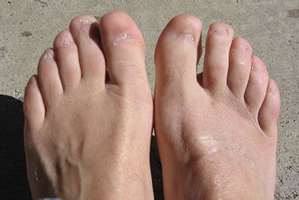 Big toe without nail healed. 17 Gnarly Sports Feet You Cannot Unsee | STACK