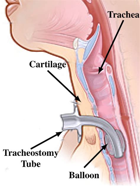 Learn vocabulary, terms and more with flashcards, games and other study tools. PDF Design of a Safer Tracheostomy Tube 1 | Semantic Scholar