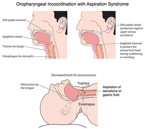 You can swallow water, but it can swallow you too in a flood. Oropharyngeal-Incoordination AspirationSyndrome- Pediatric ...