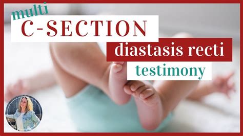 Diastasis recti (dr) is a very common condition that occurs when the abdominal muscles that run along the middle of the abdomen separate during pregnancy. diastasis recti after c section - YouTube