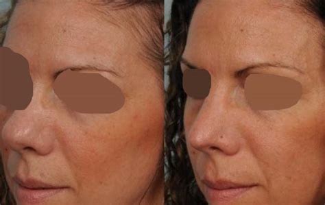 Rinoplastica Punta del Naso Cosa può correggere - Lifting Viso