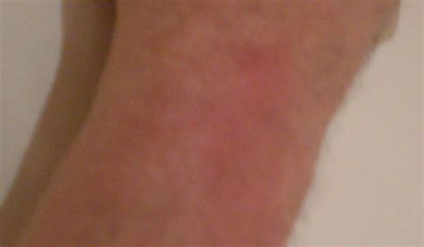 Typically, a spider bite looks like any other bug bite — a red, inflamed, sometimes itchy or painful bump on your skin — and may even. Bitten By A Redback Spider in Australia - OUCH! But what's ...