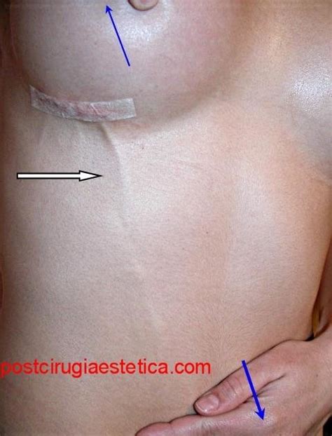 Patients with this disease often have abrupt onset of superficial pain, with possible swelling and redness of a limited area of their anterior chest wall or breast. SINDROME DE MONDOR EBOOK
