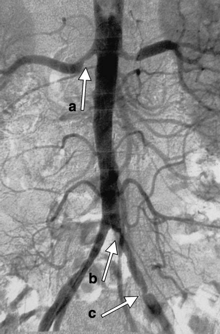 Rihal c.s., textor s.c., breen j.f. Initial arteriogram showing bilateral renal artery ...