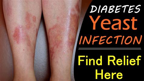 Aug 30, 2019 · however, pregnancy, menstruation, diabetes, and birth control pills can also contribute to developing a yeast infection. Diabetic Yeast Infection Home Remedies - Get Relief At ...