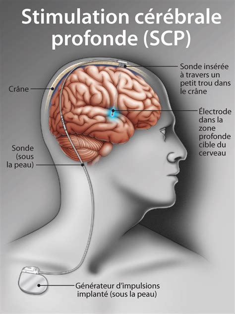 Parkinson est une maladie neurologique progressive qui se manifeste notamment par des tremblements. maladie de Parkinson | HealthPlexus.net