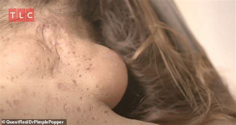 Thank you very much for reading my idea! Man gets his 'painful softball-sized' lumps removed by Dr ...
