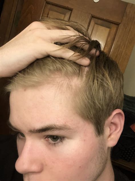 Easier said than done, i know. Am I balding? I'm 16 - Open Hair Loss Topics - Hair ...