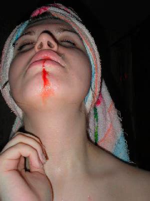 Why is there bleeding after tooth extraction? How to stop blood after tooth extraction, if the bleeding ...