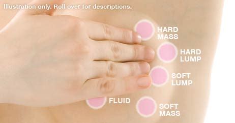 The changes are the important thing. I feel a lump in my Breast! What should I do now? - Dr ...