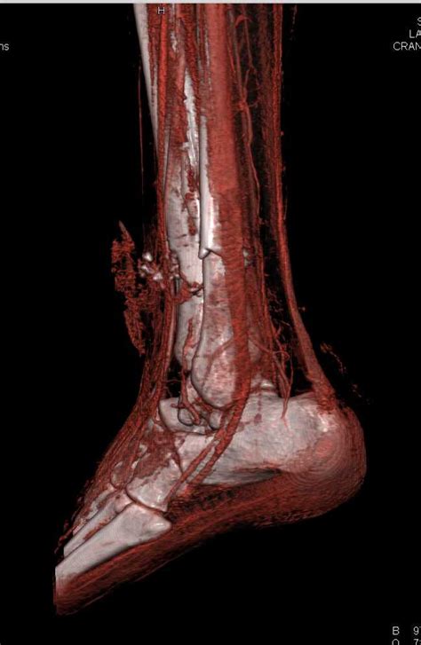 A bowed tendon is a horseman's term for a tendon after a horse has sustained an injury that caused the tendon fibers to be torn, and then healed with bowed appearance. GSW Lower Leg with Bone and Muscle Injury - Trauma Case Studies - CTisus CT Scanning