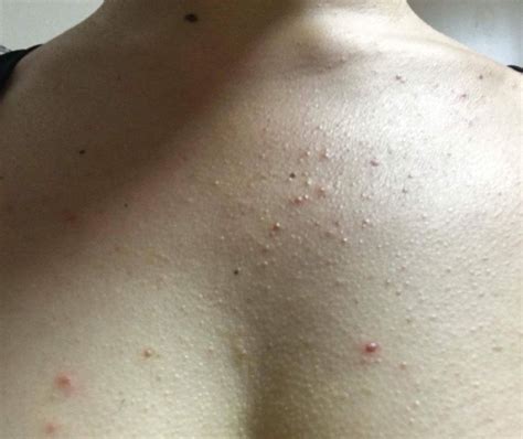 【※胸ニキビを治す化粧水!？】私の薬用VCボディミスト衝撃 ...