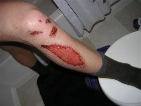 Maybe you would like to learn more about one of these? Motorcycle Road Rash | Pictures