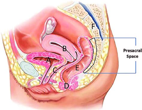 This medical exhibit features a single mid sagittal view of the female abdomen and pelvic anatomy fibrous adhesions are shown extending from the abdominal wall to the structures of the small intestines fallopian tube and the uterus other labels identify the strucutres of the umbilicus large bowel and the bladder adjacent to the adhesions. Abdominal Anatomy Chart Female : Anatomy Of The Female ...