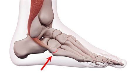 Fibularis (peroneus) longus tendon overuse and inflammation can lead to painful peroneus longus tendontis the peroneus longus muscle tendon: Peroneus Brevis Tendon Strain - Symptoms, Causes ...