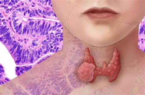 Skin cancer is the uncontrolled growth of cancer cells in the skin. About Medullary Thyroid Carcinoma | Center for Cancer ...