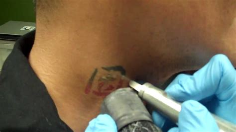 Discounted tattoo removal packages are required. Laser Tattoo Removal - Black/Red Ink - YouTube