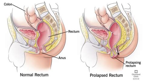 Internal hemorrhoids occur within the rectum. Hemorrhoids Pictures | Hemorrhoid Cancer Pictures