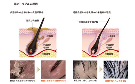 抜ける、薄くなる、細くなる…近年話題の女性の進行性ヘ ...