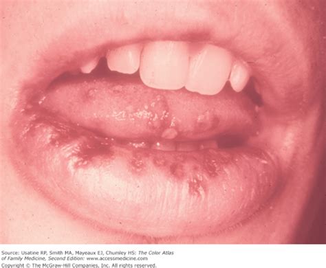 One can get infected with hsv without having any noticeable symptoms, or the. Herpes Simplex | Basicmedical Key