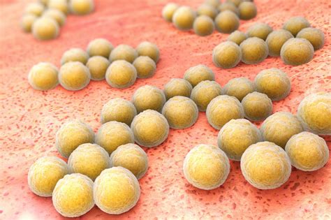 Many clinicians consider sepsis to have three stages, starting with sepsis and progressing to severe sepsis and septic shock. Sepsis - ett livshotande tillstånd - Vetenskap och Hälsa