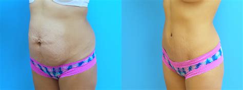 Two factors which affect on this post we will address swelling of the tissues after tummy tuck and why compression garments following surgery are important to reduce swelling. Tummy Tuck Before and After Case 16 | David J. Levens, MD