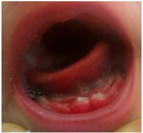 Laverne is a handy bioinformatics tool to help facilitate. Natal and neonatal teeth: two clinical cases report