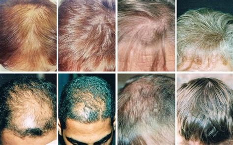 Hair highlights, hair treatments, keratin treatment. Male & Female Hair Loss Treatments in Chester