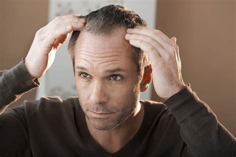 While finasteride is enough to stop hair loss for most people, dutasteride (avodart) can be a good alternative for hair loss patients looking for a more effective solution. What is Avodart (Dutasteride)? - UK Meds
