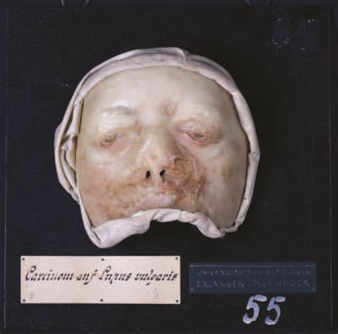 We did not find results for: Moulage, Carcinom auf Lupus vulgaris (Gesicht) [Becher ...