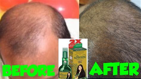 It improves the beauty and health of the hairs. kesh king hair oil HONESNT REVIEW||🔴LIVE PROFF🔴 - YouTube