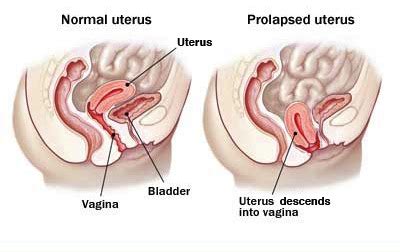 Ramai kaum wanita mengalami masalah rahim seperti cyst, fibroid dan endometriosis tapi malangnya tidak menyedarinya. CARA PENJAGAAN RAHIM YANG PERLU KITA AMALKAN - KEUNGGULAN ...