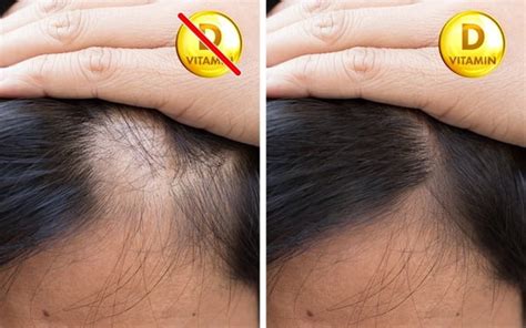 In order for you to create new hair follicles, you need vitamin d. Is Hair Loss Due To Vitamin D Deficiency Reversible?