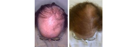 Diffuse alopecia is a condition in which the hair on the head thins out. Arztinformationen » Hair & Nail