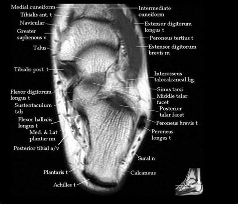 The extrinsic muscles are located in the anterior and lateral compartments of the leg. 52 best images about MRI anatomy on Pinterest | Head and ...