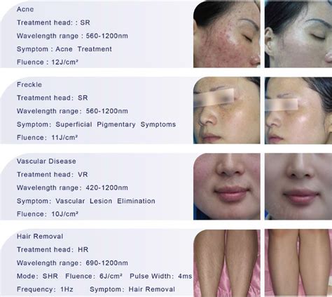 What causes skin discoloration in the. From acne treatments to rapid laser hair removal, we offer ...