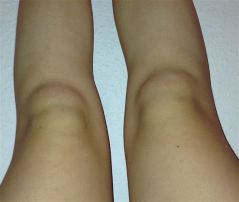 Einfache übungen für das knie. borreliose knie