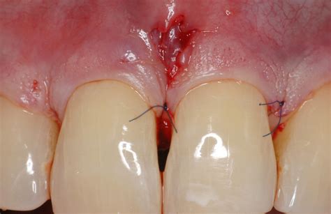 14 cases have thus far been reported. Surgical Treatment of a Cemental Tear‐Associated Bony ...