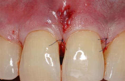 Aging, trauma and occlusal overload are the main aetiological factors. Surgical Treatment of a Cemental Tear‐Associated Bony ...