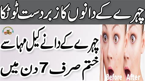 Liver ki garmi ka ilaj hair regrowth treatment provillus. Dano ka Ilaj In Urdu | Chehre Ke Dane Khatam Karne Ka ...