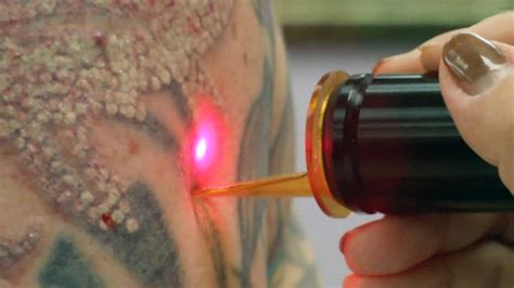 It also stops the scabs from the peeling tattoos from drying out and cracking too much. Laser Tattoo Removal - How a Tattoo is Removed - YouTube