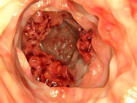 Le cancer du colon symptomes et traitement du cancer du ...
