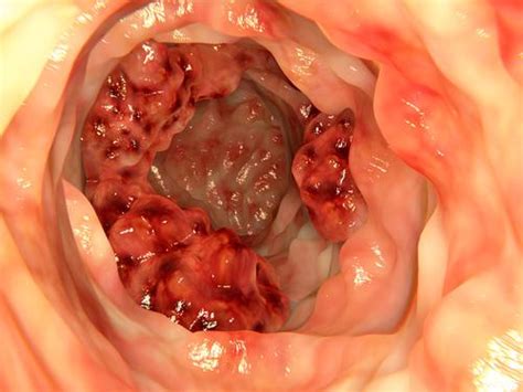 Colon cancer is highly treatable if diagnosed early. Le cancer du colon symptomes et traitement du cancer du ...