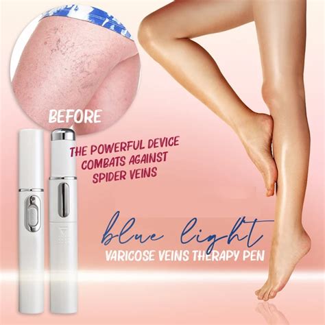 Created with the sole focus to provide excellent varicose vein treatment for our patients. Blue Light Therapy Varicose Veins Pen - Not sold in stores