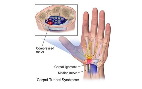 This can make your hand hurt or feel numb. Pin on Carpal Tunnel Exercises