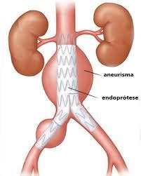 Um aneurisma cerebral pequeno costuma ser assintomático. Blog Dr. Carlos: Aneurisma