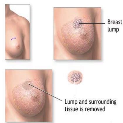 They are also often painless. TIPS TO IDENFITFY BENIGN BREAST LUMP AND CANCEROUS LUMPS ...