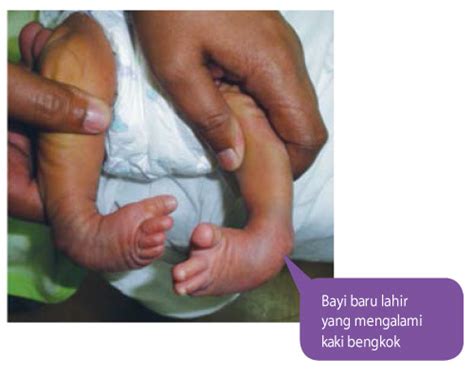 Ada juga perkataan sinonim dan berkaitan dengannya ada dipaparkan di sini. Merawat Kaki Bengkok (Clubfoot) - Positive Parenting