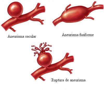 Esta debilidad ocurre habitualmente por enfermedad del vaso, que pierde su elasticidad y se vuelve más frágil. Aneurisma - O que é, tratamento - MundodasTribos - Todas ...